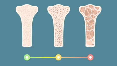 Stages of Osteoporosis: How to Stop Bone Loss in Its Tracks | Woman's World Bone Loss, Flamingo, Ups, Bones, Acting