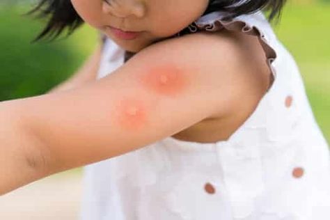 What's the difference between mosquito and bed bug bites?  https://www.bedbugsinsider.com/bed-bug-bites-vs-mosquito-bites/ Mosquito Bite Relief, Prevent Mosquito Bites, Bite Relief, Fever Symptoms, Calamine Lotion, Bed Bug Bites, Anti Itch Cream, Mosquito Control, Mosquito Bite