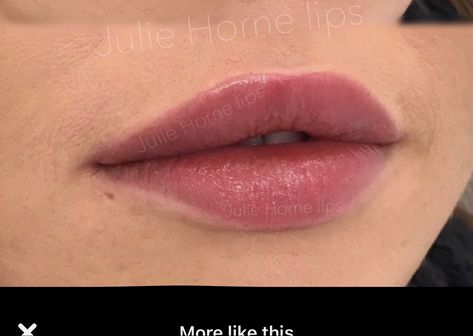 Rounded Lip Filler, Round Cupids Bow, Round Lip Filler, Round Cupids Bow Lips, Round Lips Filler, Hip Filler, Lip Injections Shapes, Rounded Cupids Bow Lips, Lips Ideas