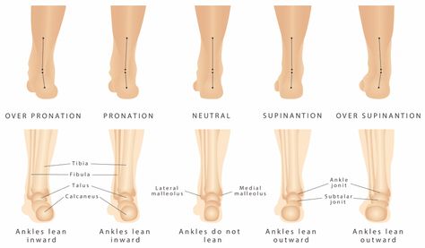 What are orthotics and how do they benefit you: Neuhaus Foot & Ankle: Podiatry