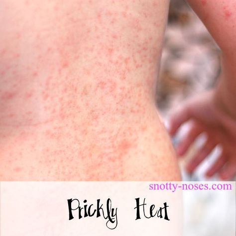 Prickly Heat Rash in Children by a pediatrician Remedies For Heat Rash, Heat Rash On Face, Treating Heat Rash, Skin Rash Remedies, Baby Heat Rash, Heat Rash Remedy, Home Remedies For Rashes, Prickly Heat Rash, Baby Skin Rash