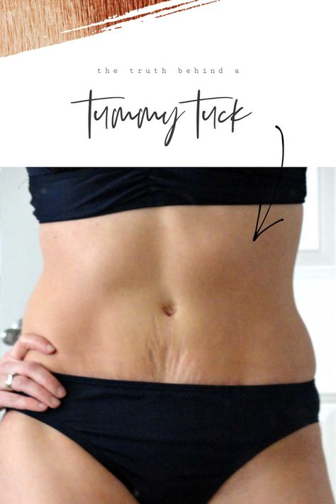 Mommy Makeover Workout, Hide Mommy Pouch Outfits, Tummy Tucks Recovery List, Tummy Tucks Tattoo Cover Up, Tummy Tucks Before And After, Mommy Makeover Surgery Recovery, Mummy Makeover, Under Breast Tattoo, Tummy Tucks Recovery