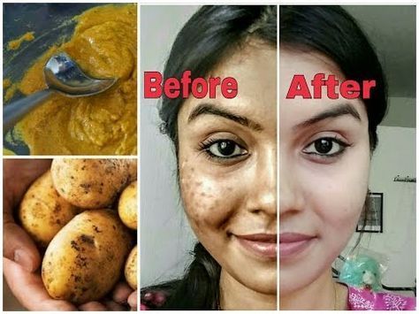 How to Give Your Skin a Boost with Potato Juice | TipHero Best Dark Spot Remover, Potato Juice, Dark Spots On Face, Overnight Beauty, Dark Spots On Skin, Dark Spot Corrector, Spots On Face, Remove Dark Spots, Mascara Facial