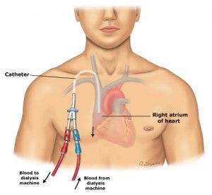 CLABSI: Central Line Associated Blood Stream Infection. Follow our blogs to stay up to date on the latest case studies and statistics about CLABSI and patients. #ZeroInfection #Patients #CVCHealthCare #CLABSI #Educating Central Venous Catheter, Central Line, Infection Prevention, Nursing School Notes, Nursing Tips, Nursing Career, Medical Field, Tampa Fl, Bergamo