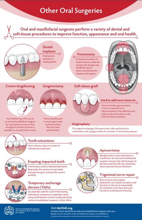 While there are some commonly known oral surgeries, there are also less commonly known! Renectomy, Crown-lengthening, Gingivectomy, Soft Tissue Grafts, Tooth Extractions, Erupting Impacted Teeth, Temporary Anchorage Devices (TADs), Apicoectomy, Trigeminal Nerve Repair. Dental Assistant Study, Oral Maxillofacial, Kedokteran Gigi, Kesehatan Gigi, Dental Hygiene School, Dentistry Student, Oral Surgeon, Gum Care, Teeth Care