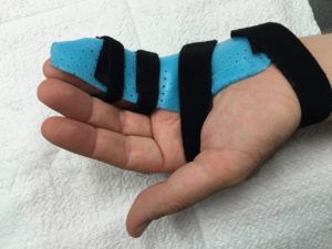 broken finger http://handtherapy.com.au/broken-finger/ Finger Fracture Snap, Fractured Finger, Avulsion Fracture, Removable Braces, Types Of Fractures, Broken Finger, Healthy Healing, Finger Hands, Shoulder Surgery