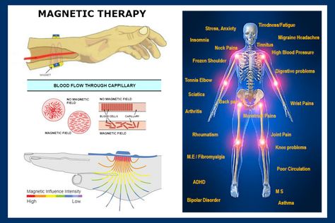 Magnetic Therapy is a holistic therapy that is most commonly known for it's ability to alleviate pain. However, this natural therapy offers numerous other health benefits... visit website to read more  #magnetictherapy #alternativetherapy #holistichealth #accesspossibilities Tms Therapy, Alternative Therapy, Holistic Therapy, Magnet Therapy, Chi Energy, Magnetic Therapy Bracelets, Energy Therapy, Magnetic Therapy, Holistic Therapies