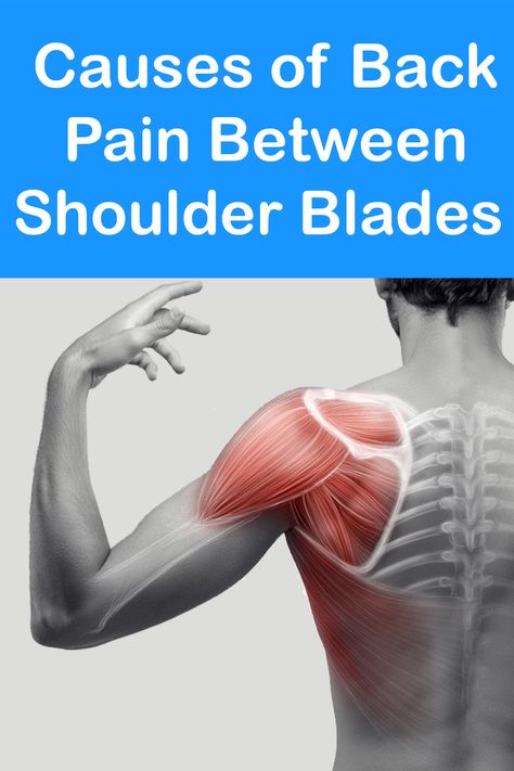 If you have back pain between shoulder blades, it can really affect your day to day life. Learn the causes of pain between shoulder blades. Stretches For Shoulder Blades, Shoulder Blade Pain Relief, Pain Between Shoulder Blades, Shoulder Pain Remedies, Causes Of Back Pain, Natural Remedies For Migraines, Middle Back Pain, Elbow Pain, Back Stretches For Pain