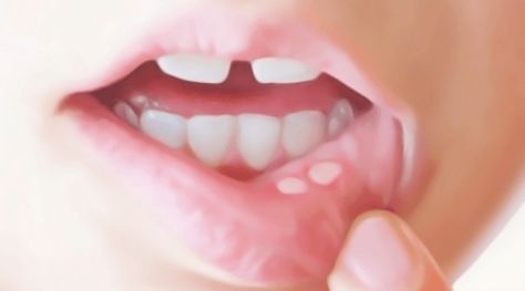 Canker Sores Mouth Blister Remedy, Blister In Mouth, Canker Sore Home Remedies, Blister Remedies, Mouth Blisters, Ulcer Remedies Mouth, Canker Sore Remedy, Mouth Problems, Fever Blister