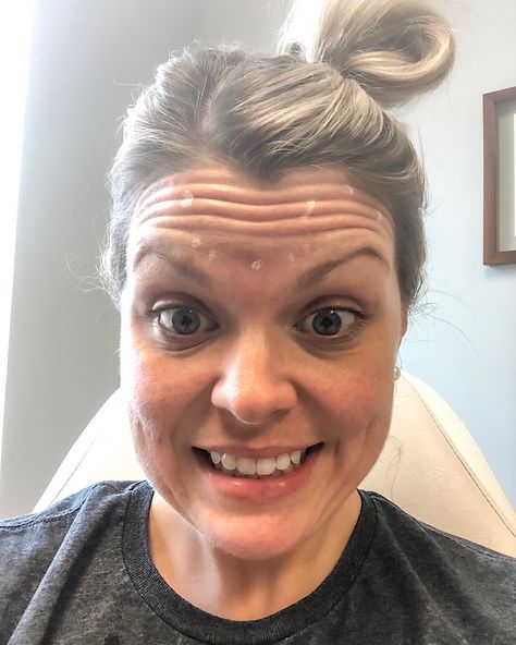 My First Botox Experience! – Food, Fitness, and Beauty Botox Alternative Products, Botox Eyes, Botox Forehead, Botox Results, Botox Cost, Botox Training, Botox Wrinkles, Botox Brow Lift, Natural Botox