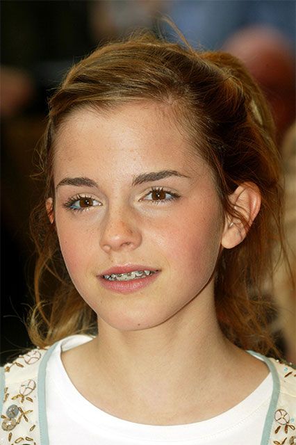 Stylish Braces For Adults Celebrities With Braces, White Braces, Braces Girls, Cute Braces, Brace Face, Braces Colors, Bailee Madison, Teeth Braces, Faith Hill