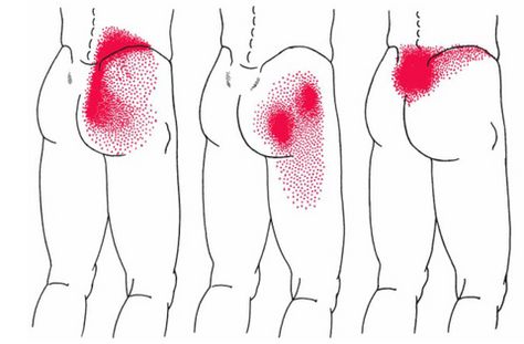 Gluteus Medius Muscle | Anatomy, Function, Pain, & Relief Hip Muscles Anatomy, Gluteus Medius Exercises, Muscles Anatomy, Running Muscles, Glute Medius, Anatomy Images, Referred Pain, Muscle Knots, Single Leg Deadlift