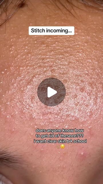 Matt Randon 🧩 on Instagram: "HOW TO GET RID OF BUMPY SKIN!😱 (follow for more!💗)  #skincarecommunity #skincarejunkie #skincareroutines #skincarelover #beautyaddict #beautyobsessed #acnetreatment #acneproblems #acnetips" Skin Care Products For Bumpy Skin, Skin Care Bumpy Skin, Heat Bumps On Face, Skin Care For Bumpy Skin, How To Get Rid Of Bumps On Forehead, How To Get Darker Skin, Bumpy Face Skin, How To Get Rid Of Cystic Pimples, How To Get Rid Of Bumpy Skin