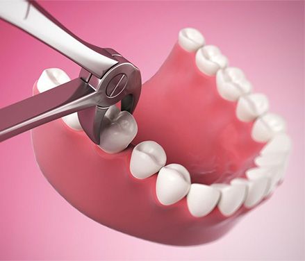 Impacted Tooth, Affordable Dental Implants, Wisdom Tooth Extraction, Wisdom Tooth, Dental Implant Surgery, Wisdom Teeth Removal, Tooth Removal, Dental Bridge, Dental Veneers