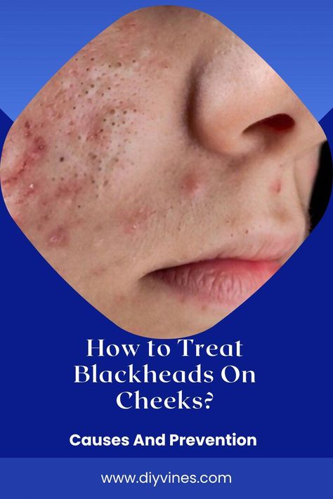 Do you want to know How To Treat big blackheads on cheeks? big blackheads on cheeks are blackish or yellowish bumps and are basically a kind of acne vulgaris. How To Treat Blackheads, Blackheads On Cheeks, Skin Blackheads, Blackhead Remedies, Acne Vulgaris, Prevent Pimples, Cold Sores Remedies, How To Get Rid Of Pimples, Natural Sleep Remedies