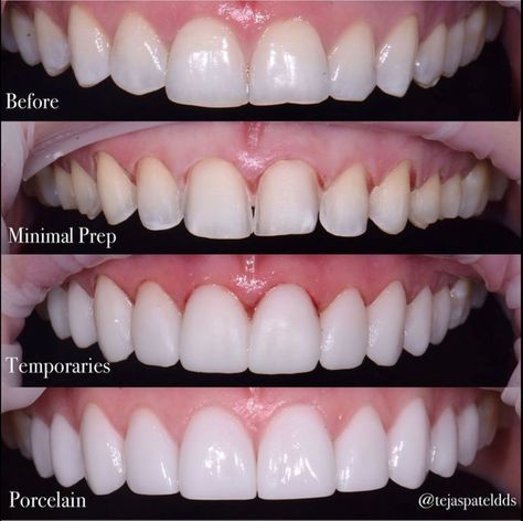 Veneers Best Veneers Teeth, Veneers Black Women, Porcelain Veneers Before And After, Bad Veneers, Veneers Teeth Styles, Celebrity Veneers, Veneers Before And After, Celebrities With Veneers, Veneers Aesthetic