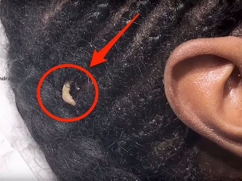 Dr. Pimple Popper found a bizarre growth like a fingernail on a patient's head Pimple Inside Nose, Head Pimples, Huge Pimple, Ear Pimple, Pimple Popper Tool, Honey Face Cleanser, Blind Pimple, Pimples Under The Skin, Makeup Life Hacks