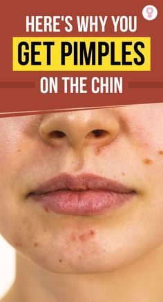 Chin Pimples, Remedies For Back Acne, Face Breaking Out, Pimple Causes, Back Acne Remedies, Chin Acne, Small Pimples, Painful Acne, Back Acne