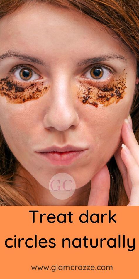 Homemade Remedies For Dark Circles, Dark Eye Circles Remedies, Black Circles Under Eyes Remedies, Dark Circles Natural Remedy, Dark Circles Under The Eyes Remedies Natural Treatments, Dark Puffy Circles Under Eyes, Dark Eye Circles How To Get Rid Of, How To Get Rid Of Dark Circles Under Eye Naturally, How To Fix Dark Circles