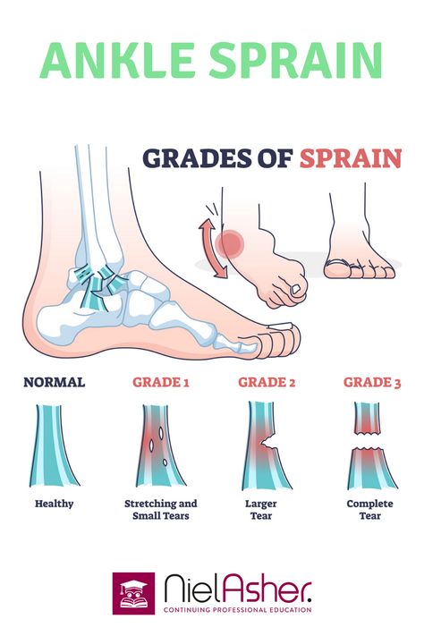 Sprained Ankle Remedies, Ankle Sprain, Trigger Point Therapy, Ankle Pain, Sprained Ankle, Deep Breathing Exercises, Health Trends, Medical Terms, Hip Pain