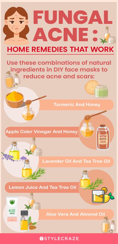 Back Acne Remedies, Face Acne Treatment, Blind Pimple, Fungal Acne, Acne Vulgaris, Diy Acne, Natural Acne Remedies, Natural Acne, Home Remedies For Acne