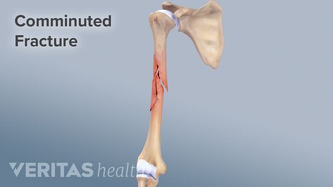 Comminuted Fracture Definition - Spine-health.com Glossary Types Of Fractures, Health Websites, Hairline Fracture, Bone Fracture, Spine Health, Sports Injury, Sports Health, Medical Professionals, Ahmedabad