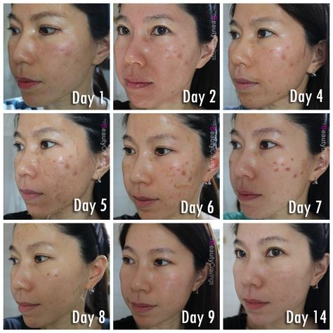 Clear Flawless Skin, Vi Peel, Derma Rolling, Facial Scars, Acid Peel, Sweet Caroline, Behind Closed Doors, Peeling Skin, Self Concept