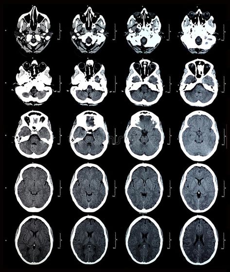 Brain Tumour Ct Scan, Ct Scan Brain, Diagnostic Radiography, Scanning Stand, Computed Tomography, Samurai Mask, Brain Scan, Andrew Martin, Ct Scan