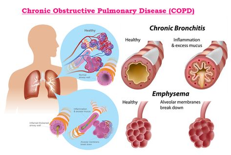 Chronic obstructive pulmonary disease (COPD) is a progressive life¬ threatening lung disease characterized by chronic obstruction of lung airflow that interferes with normal breathing and is not fully reversible and also that causes breathlessness (initially with exertion) and predisposes to exacerbations & serious illness. The most common conditions are emphysema and chronic bronchitis. Emphysema and chronic bronchitis are the two most common conditions that contribute to COPD. Emt Study, Chest Infection, Arterial Blood Gas, Medical Study, Lung Conditions, Study Essentials, Oxygen Therapy, Chronic Obstructive Pulmonary Disease, Respiratory Therapy