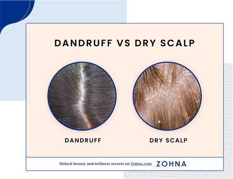 Dandruff vs Dry Scalp Guide: Differences, Causes & Solutions Dry Scalp Vs Dandruff, What Causes Dandruff, Scalp Spa, Dandruff Causes, Dandruff Solutions, Home Remedies For Dandruff, Dandruff Remedy, Oily Scalp, Itchy Scalp