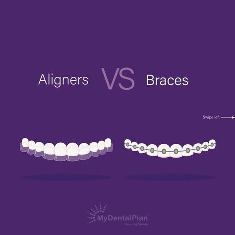 Deciding between braces and aligners can be confusing. According to a survey conducted by American Dental Association in 2015, It’s reported that 25% of people avoid smiling due to the condition of their mouth and teeth. 

An invisible teeth aligner or a metal brace may help you achieve a smile you're proud of if you're experiencing embarrassment due to crooked or misaligned teeth. However, you must weigh the pros and cons before choosing between aligners and braces. 



#MyDentalPlan Aligners For Teeth, Dental Marketing Social Media, Teeth Aligners, Braces Ideas, Dental Wall Art, Dental Branding, Types Of Braces, Dental Advertising, Misaligned Teeth