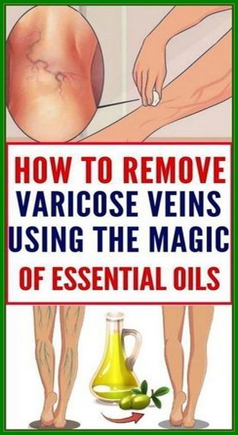 How To Remove Varicose Veins Using The Magic of Olive Oil Varicose Vein Removal, Varicose Vein Remedy, Medicine Book, Herbal Oil, Healthy Lifestyle Tips, Natural Treatments, Health Awareness, Natural Healing, Most Powerful