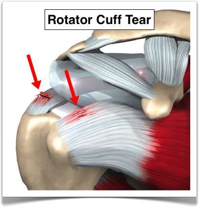 Rotator Cuff Rehab, Rotator Cuff Pain, Shoulder Anatomy, Rotator Cuff Surgery, Rotator Cuff Exercises, Psoas Release, Shoulder Rehab, Rotator Cuff Tear, Shoulder Injury