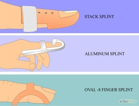 Surgical Art, Hand Splint, Nbcot Exam, Mallet Finger, Rehabilitation Equipment, Sports Massage Therapy, Finger Splint, Infant Lesson Plans, Finger Exercises