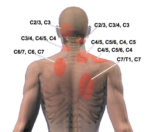 Cloward sign & Cervical Referral Patterns | Modern Manual Therapy Blog Punkty Spustowe, Forward Head Posture Exercises, Occipital Neuralgia, Cervical Pain, Referred Pain, Chronic Back Pain, Cervical Spondylosis, Nerve Pain Relief, Sciatic Nerve Pain