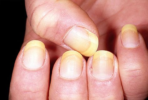 Subtle changes in the color or texture of your nails may be a sign of disease… Nail Symptoms, Fingernail Health, Nail Remedies, Nail Infection, Yellow Nail, Fungal Nail, Toenail Fungus, Nail Fungus, Nail Health