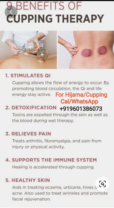 Cupping Marks Meaning, Shoulder Cupping Points, Fire Cupping Therapy, Back Cupping Therapy, Cupping Therapy Placement Chart, Hijama Cupping Therapy Benefits, Dry Cupping Therapy Chart, Benefits Of Cupping Therapy, Cupping Therapy Chart Trigger Points