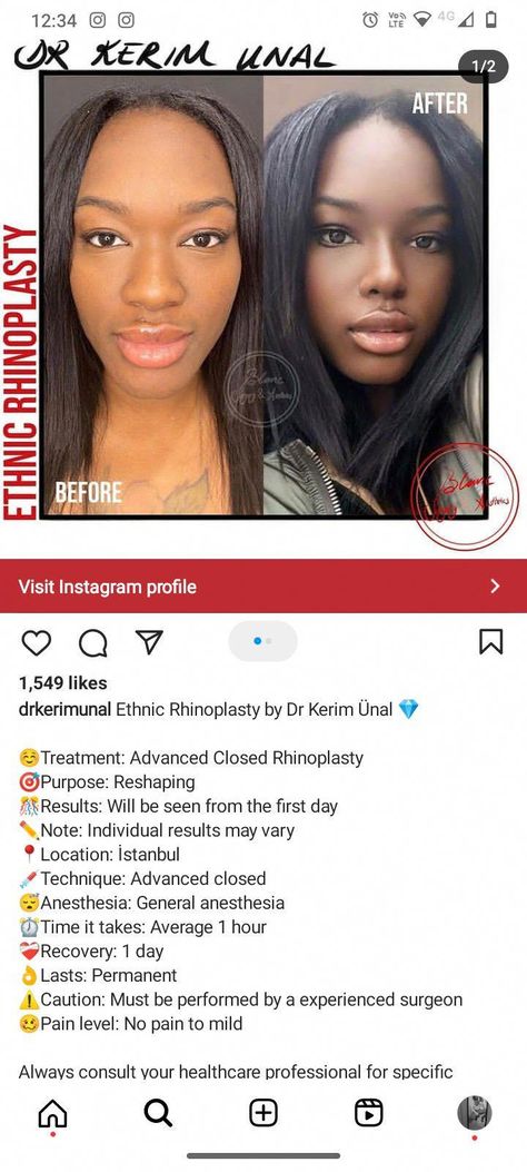 Black Rhinoplasty Before And After, Rhinoplasty Before After Wide Nose Jobs, African American Rhinoplasty, Rhinoplasty Black Women, Black Nose Job, Ethnic Rhinoplasty African Americans, Nose Job Black Women, Wide Nose Women, Wide Nose Rhinoplasty