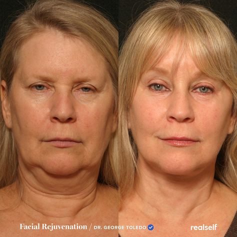 Excess droopy skin along the jawline and below the cheeks is commonly referred to as jowls. These nonsurgical and surgical procedures can help tighten the skin. How To Lift Sagging Jowls, How To Help Sagging Jowls, Sagging Facial Skin, Plasma Fibroblast Before And After Neck, How To Tighten Jawline, Neck Lift Naturally, How To Reduce Sagging Jowls, How To Tighten Saggy Jowls, Tighten Saggy Jowls