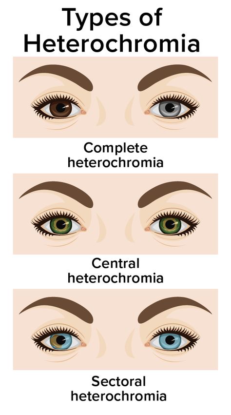 Eye Color Heterochromia, 2 Different Color Eyes, Types Of Heterochromia, Heterochromia Eyes Aesthetic, Central Heterochromia Eyes, Heterochromatic Eyes, Different Types Of Heterochromia, Beauty Subliminal, Complete Heterochromia