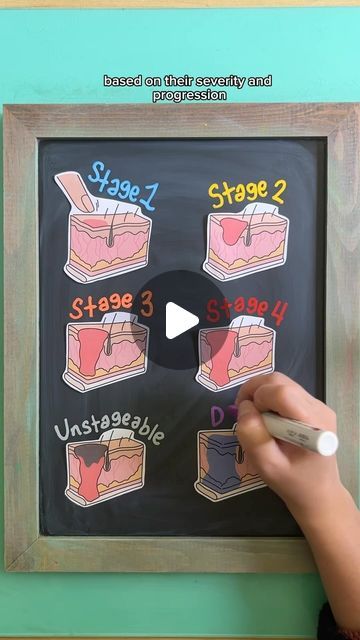 Allorah Foote, BSN, RN, CCRN | NCLEX & Nursing School Resources on Instagram: "🩹 PRESSURE INJURY STAGES  follow @nursewellversed for visual nursing education  A pressure injury is a breakdown of skin integrity due to unrelieved pressure. There are different stages of pressure injuries that are classified based on their severity and progression.  1️⃣ Stage 1 →Non-blanchable redness →Skin is NOT open but appears swollen and irritated  2️⃣ Stage 2 →Skin NOT intact →Shallow, open ulcer with partial thickness skin loss →NO fat or muscle exposed  3️⃣ Stage 3 →Full thickness skin loss →Subcutaneous fat visible →NO exposed bone, muscle, or tendon  4️⃣ Stage 4 →Full thickness skin loss →Bone, muscle, or tendon IS exposed →Tunneling or pockets may be present  ⚫️ Unstageable →Base covered with escha Pressure Injury, Nursing School Success, Redness Skin, Study Sheet, Med Surg Nursing, Pressure Ulcer, Nclex Study, Fundamentals Of Nursing, Med Surg