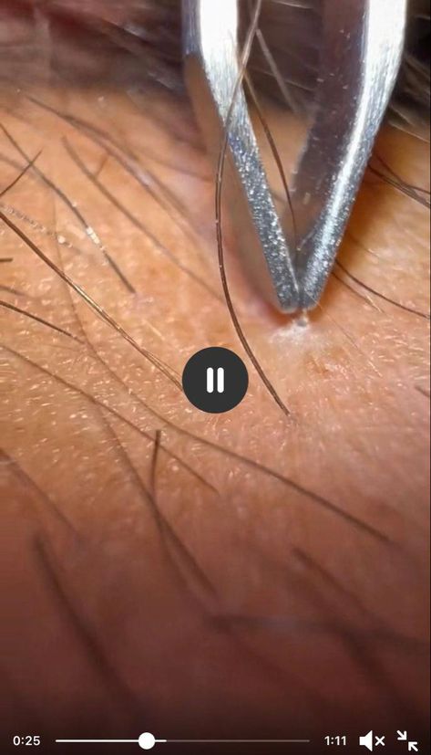 How To Get Rid Of Ingrown Hairs, Ingrown Hair Removal Videos, Remove Ingrown Hair, Get Rid Of Ingrown Hairs, Blackheads Removal Cream, Ingrown Hair Remedies, Shaving Bumps, Face Acne Treatment, Blackhead Remover Diy