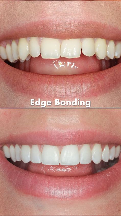 This is a beautiful example of how small changes using edge bonding can completely transform your smile. Dr Fearghal applies composite bonding directly to the teeth to even out the worn edges and fill any spaces. The result is a brilliant, stunning, confident smile. . 😁 Transform Your Smile 💰 From €250 Per Tooth 💶 Edge bonding €150 Per Tooth 👨🏻‍⚕️ Free Consultation 🚧 No Drilling 🦷 No Change to Tooth Structure 🚫 Pain-Free 💶 €50 Refundable Deposit 💳 Payment Plans 🗓 Lasts 5-7 Years Short Teeth Smile, Teeth Cosmetic Dentistry, Small Teeth Smile, Celebrities With Veneers, Composite Bonding Teeth, Teeth Composite, Dream Teeth, Perfect Teeth Smile, Teeth Makeover