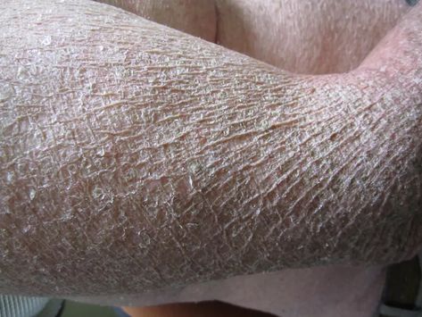 What Is Acquired Ichthyosis? Ichthyosis Vulgaris, Fish Photo, Scale Skin, Unique Fish, Skin Disorders, Fish Scale, Fish Scales, The Skin, Fish