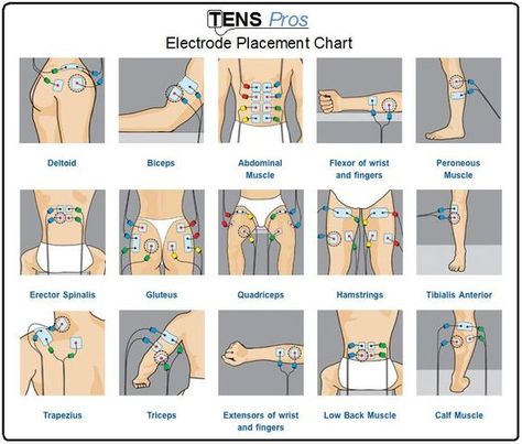 TENS unit electrode placement chart for different sports/life injuries. Repinned by SOS Inc. Resources pinterest.com/sostherapy/.: Tens Electrode Placement, Tens Unit Placement, Tens And Units, Tens Machine, Tens Unit, Guided Visualization, Ten Unit, Nerve Pain Relief, Peaceful Sleep