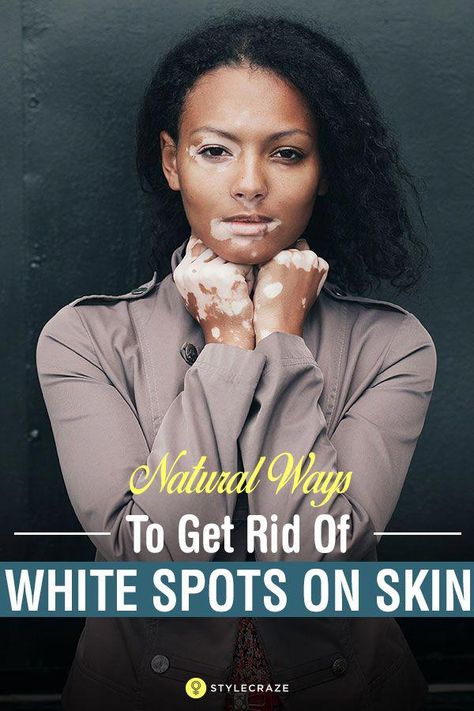 21 Natural Ways To Get Rid Of White Spots On Skin (Vitiligo) #NaturalRemediesForSickness White Spots On Skin, Spots On Skin, Remove Skin Tags Naturally, Weight Changes, Skin Spots, Lose 40 Pounds, Natural Home Remedies, Medical Prescription, Skin Conditions