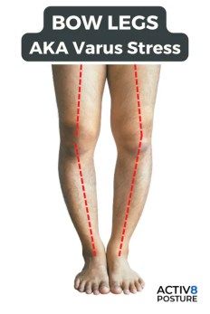 Bow Legs Bow Legged Women, Genu Valgum, Genu Varum, Peroneus Longus, Bow Legged Correction, Calf Strain, Knock Knees, Pelvic Organ Prolapse, Bow Legged