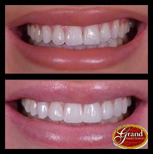 Composite Bonding Before And After, Composite Bonding Teeth, Teeth Makeover, Ceo Style, Cosmetic Bonding, Teeth Bonding, Composite Bonding, Teeth Aesthetic, Pretty Teeth