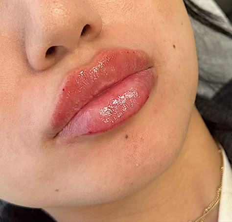 Russian lip technique 💉 #lipfiller #russianlips #russianliptechnique Russian Lips Filler 1ml, Lip Filler Inspiration 1ml, Russian Lip Filler Technique, Lip Fillers Before And After 1ml, Downturned Lips, Russian Lips Filler, Lip Pmu, 1ml Lip Filler, Dermal Fillers Lips