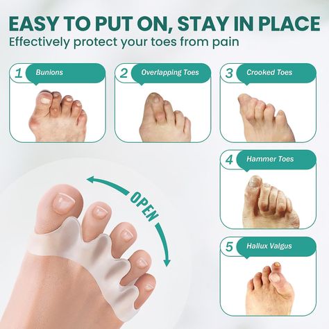 Amazon.com: Welnove Toe Separators to Correct Bunions - 8 Pack Silicone Toe Spacers for Feet Men Women - Aloe Vera Infused Toe Straighteners for Bunion, Hammertoe - Toe Stretchers for Yoga Practice : Health & Household Hammer Toe Correction, Thigh Bands, Toe Straightener, Toe Spacers, Toe Separator, Gel Toes, Improve Posture, Healthy Fitness, Silicone Material